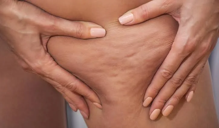 Piel con celulitis en el muslo