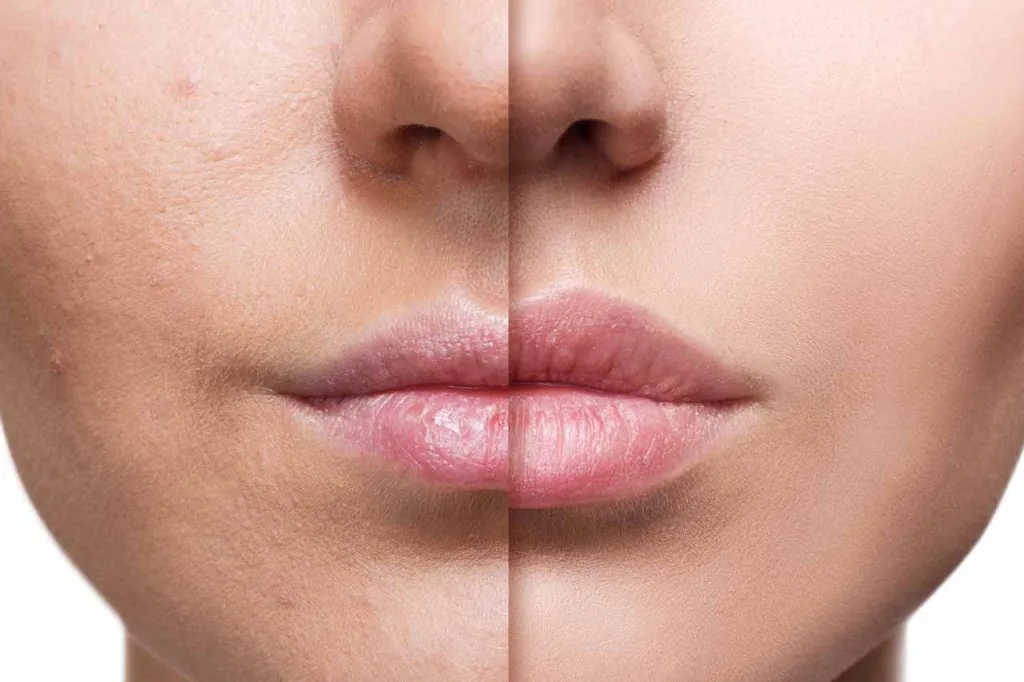Labios antes y después de la escultura labial